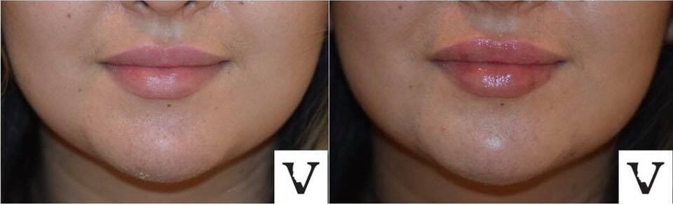 lip augmentation boston
