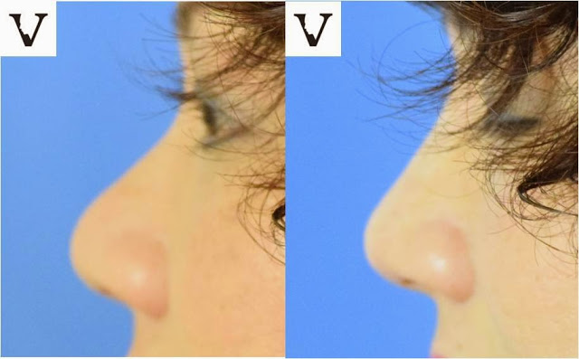 What are the criteria for a perfect nose shape?Can I get it?