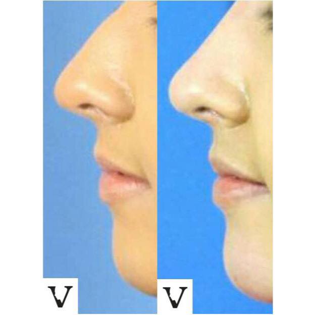 The Art of Nose Slimming with Muscle Relaxants: A Non-Surgical