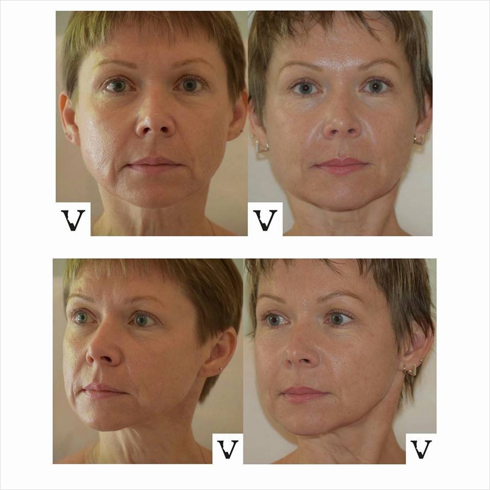 Tired Of Masculine Look Jaw Try Botox Face Slimming Visage, 47% OFF