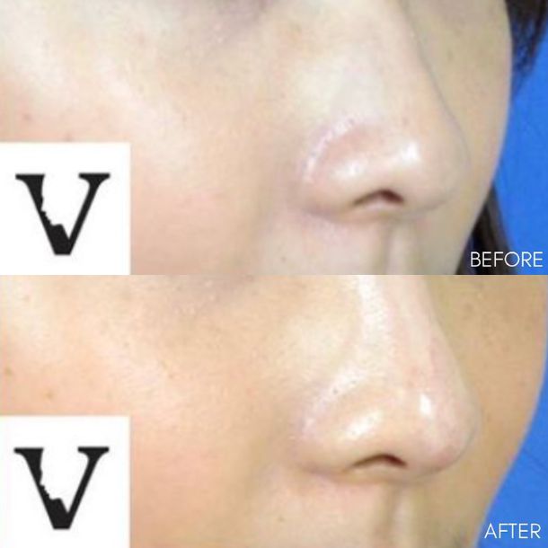 asian nose job